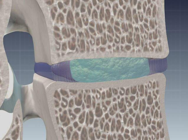 Schmerzfrei durch Bandscheibenrückzug